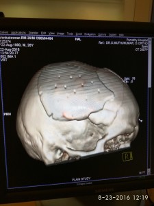 3D image after implant